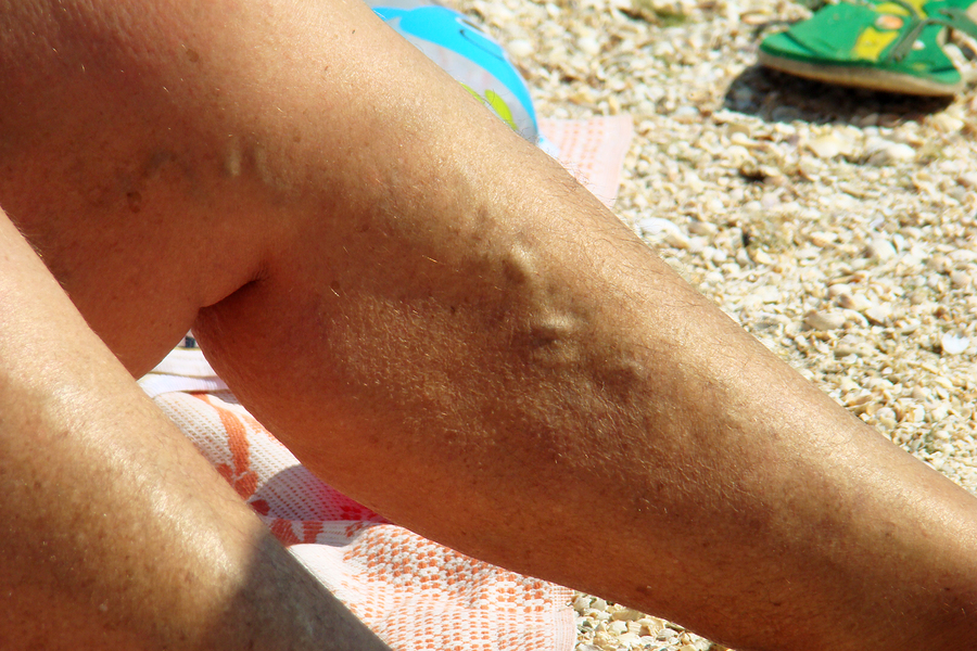 Painful varicose veins